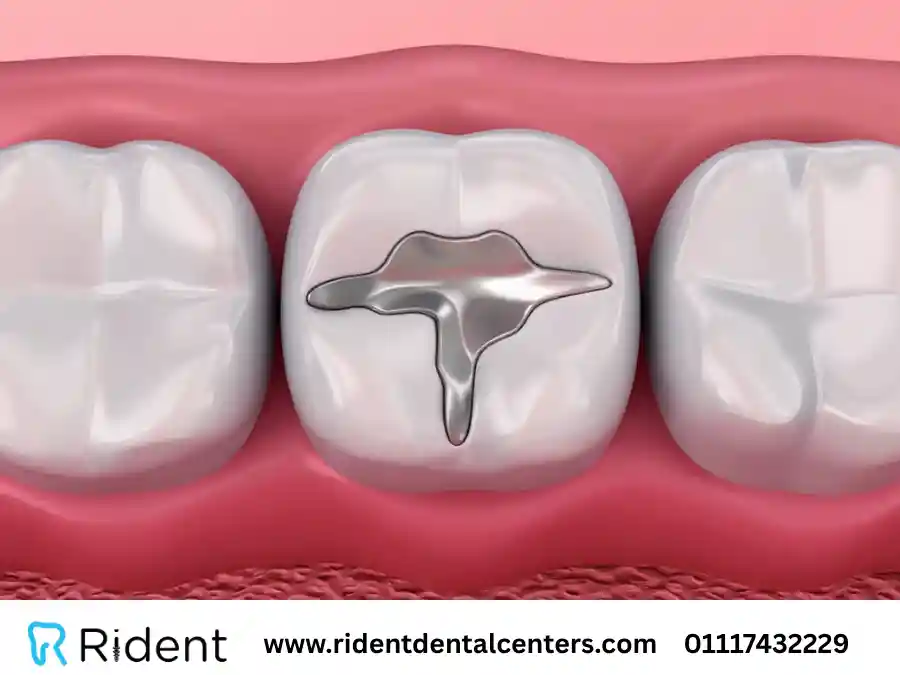 حشو الاسنان لعلاج التسوس والتآكل في 7 خطوات